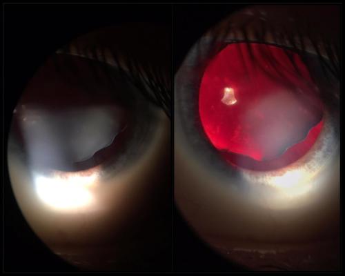 Crystalline lens dislocation in the suspect Marfan syndrome